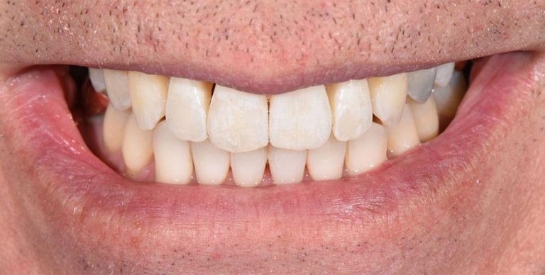 After - Crown Bank Dental