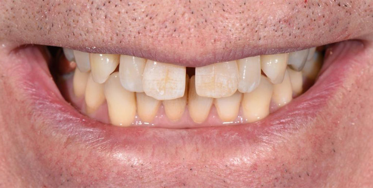 Before - Crown Bank Dental