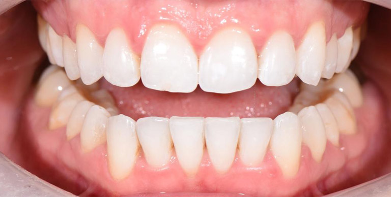 After - Crown Bank Dental