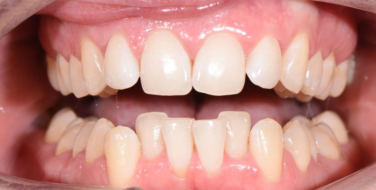 Before - Crown Bank Dental