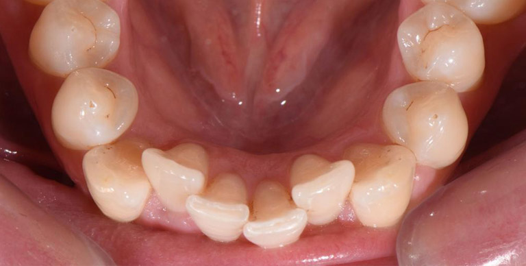 Before - Crown Bank Dental