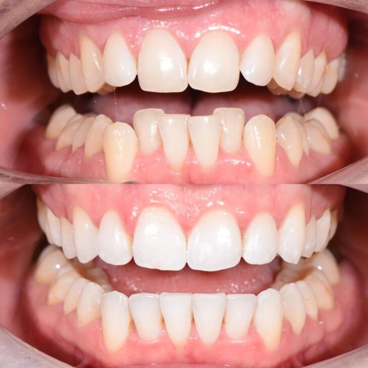 Smile Gallery - Crown Bank Dental