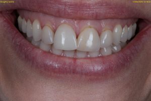 veneers treatment at crown bank dental before image