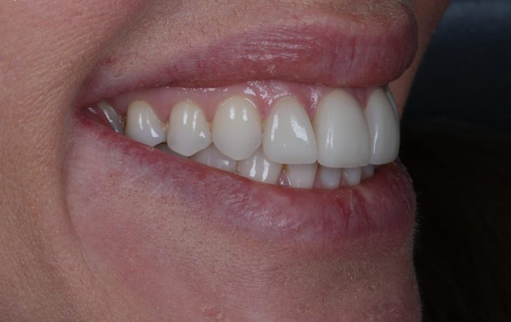 veneers treatment at crown bank dental after