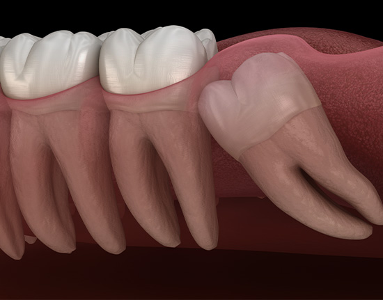Wisdom tooth removal procedure at Crown Bank Dental Cheshire