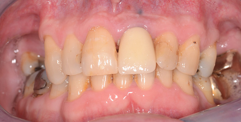 After - Crown Bank Dental