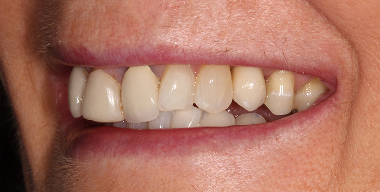 After - Crown Bank Dental