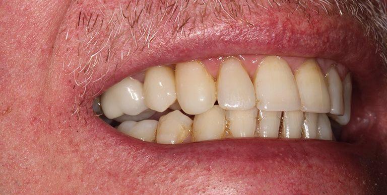 After - Crown Bank Dental