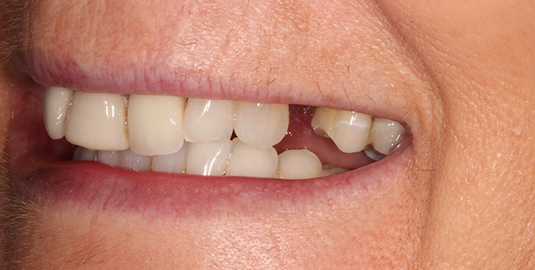 Before - Crown Bank Dental