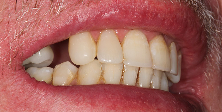 Before - Crown Bank Dental